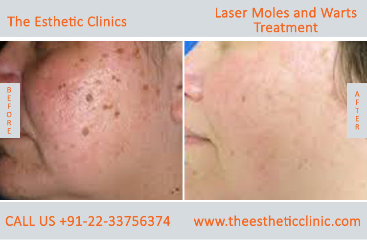 Moles Wart Skin Tags Laser Treatment before after photos in mumbai india (3)